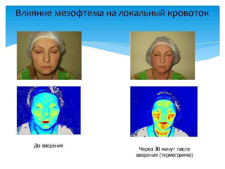 Влияние мезофтема на локальный кровоток До введения Через 30 минут после введения (термограмма) 