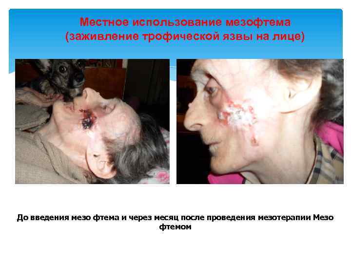 Местное использование мезофтема (заживление трофической язвы на лице) До введения мезо фтема и через