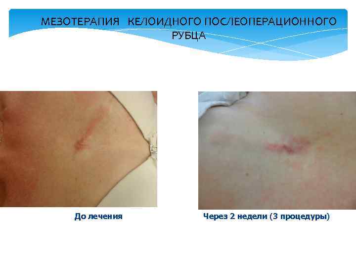 МЕЗОТЕРАПИЯ КЕЛОИДНОГО ПОСЛЕОПЕРАЦИОННОГО РУБЦА До лечения Через 2 недели (3 процедуры) 