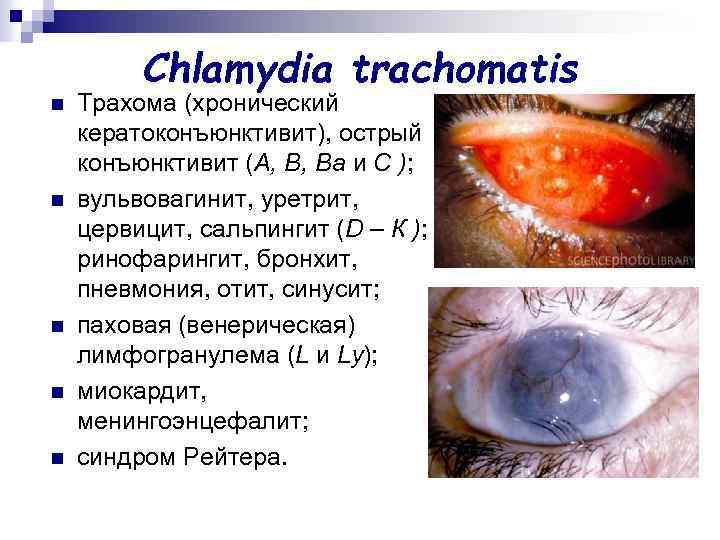 Chlamydia trachomatis n n n Трахома (хронический кератоконъюнктивит), острый конъюнктивит (А, В, Ва и