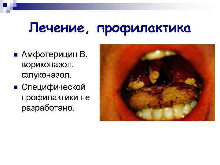 Лечение, профилактика n n Амфотерицин В, вориконазол, флуконазол. Специфической профилактики не разработано. 