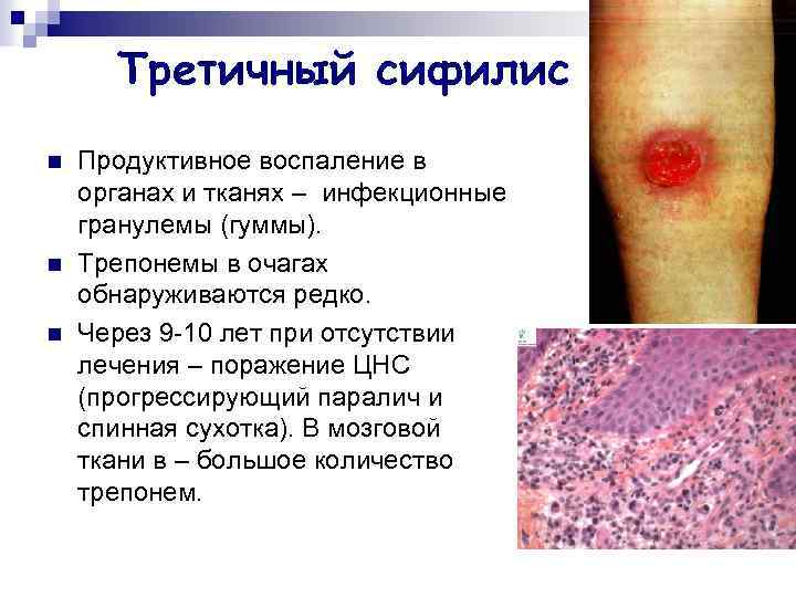 Третичный сифилис n n n Продуктивное воспаление в органах и тканях – инфекционные гранулемы