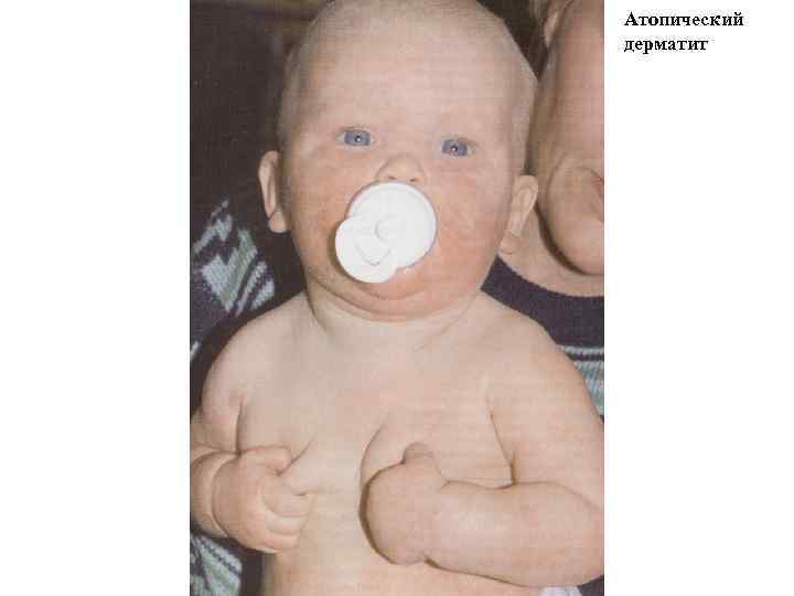 Атопический дерматит 