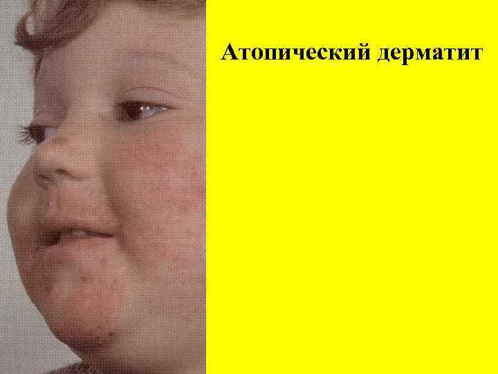 Атопический дерматит 
