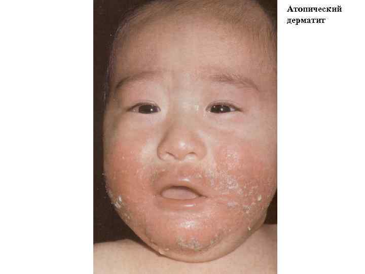 Атопический дерматит 
