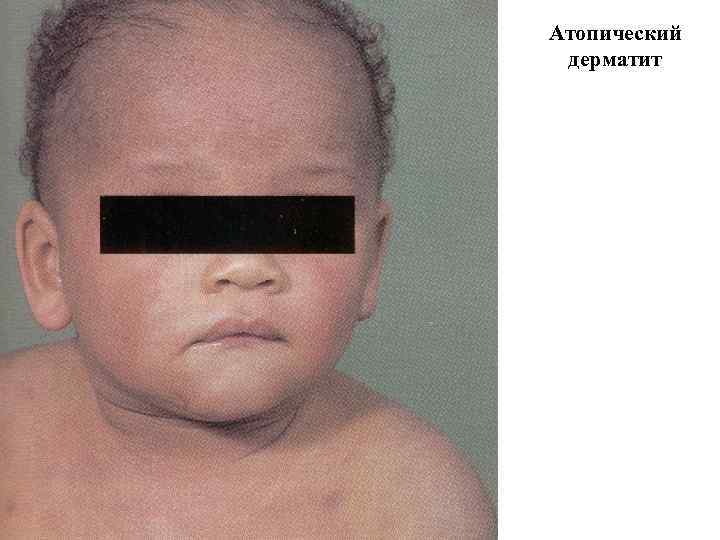 Атопический дерматит 