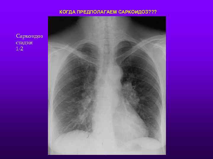 КОГДА ПРЕДПОЛАГАЕМ САРКОИДОЗ? ? ? Саркоидоз стадия 1 -2 