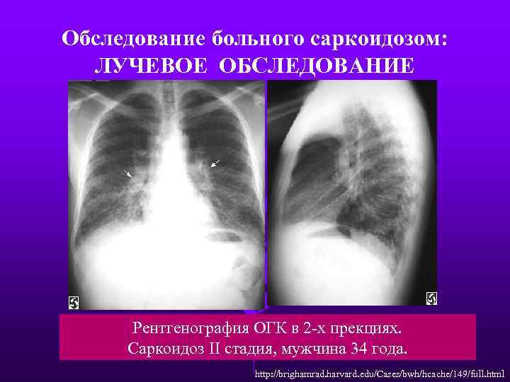 Обследование больного саркоидозом: ЛУЧЕВОЕ ОБСЛЕДОВАНИЕ Рентгенография ОГК в 2 -х прекциях. Саркоидоз II стадия,