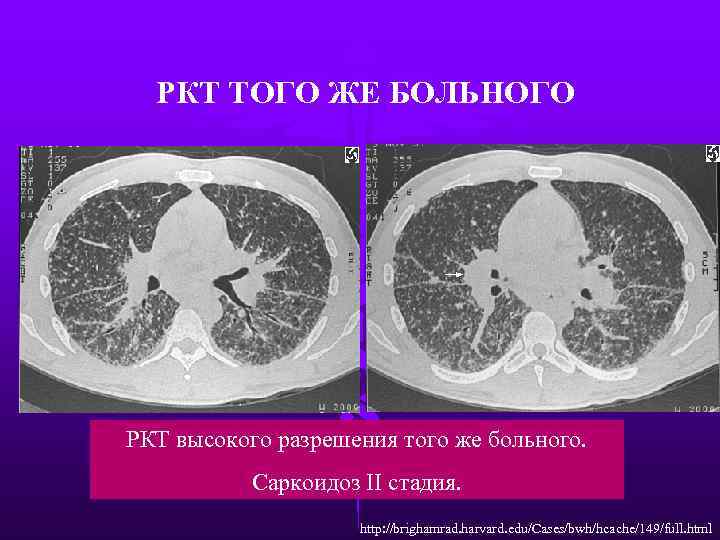 РКТ ТОГО ЖЕ БОЛЬНОГО РКТ высокого разрешения того же больного. Саркоидоз II стадия. http: