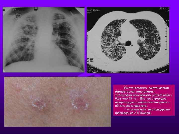 Рентгенограмма, рентгеновская компьютерная томограмма и фотография изменённого участка кожи у больного 45 лет. Диагноз