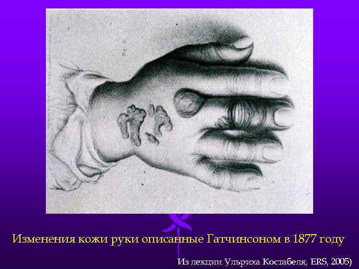 Изменения кожи руки описанные Гатчинсоном в 1877 году Из лекции Ульриха Костабеля, ERS, 2005)