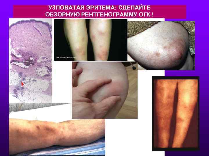 УЗЛОВАТАЯ ЭРИТЕМА: СДЕЛАЙТЕ ОБЗОРНУЮ РЕНТГЕНОГРАММУ ОГК ! 