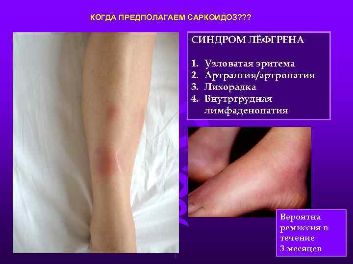 КОГДА ПРЕДПОЛАГАЕМ САРКОИДОЗ? ? ? СИНДРОМ ЛЁФГРЕНА 1. 2. 3. 4. Узловатая эритема Артралгия/артропатия