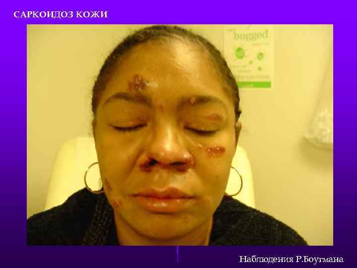 САРКОИДОЗ КОЖИ Наблюдения Р. Боугмана 