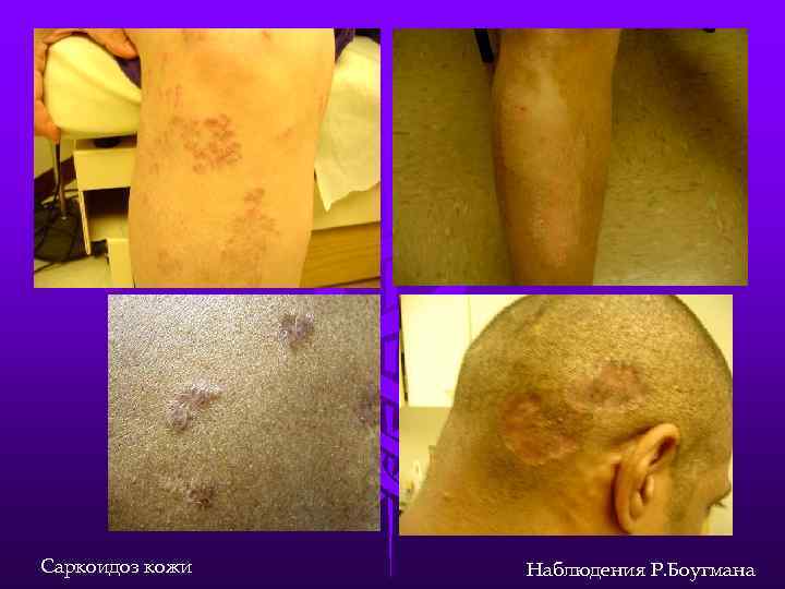 Саркоидоз кожи Наблюдения Р. Боугмана 