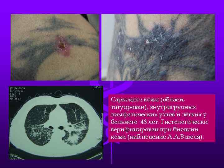 Саркоидоз кожи (область татуировки), внутригрудных лимфатических узлов и лёгких у больного 48 лет. Гистологически