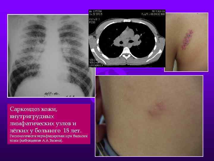 Саркоидоз кожи, внутригрудных лимфатических узлов и лёгких у больного 18 лет. Гистологически верифицирован при