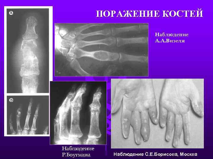 ПОРАЖЕНИЕ КОСТЕЙ Наблюдение А. А. Визеля Наблюдение Р. Боугмана Наблюдение С. Е. Борисова, Москва