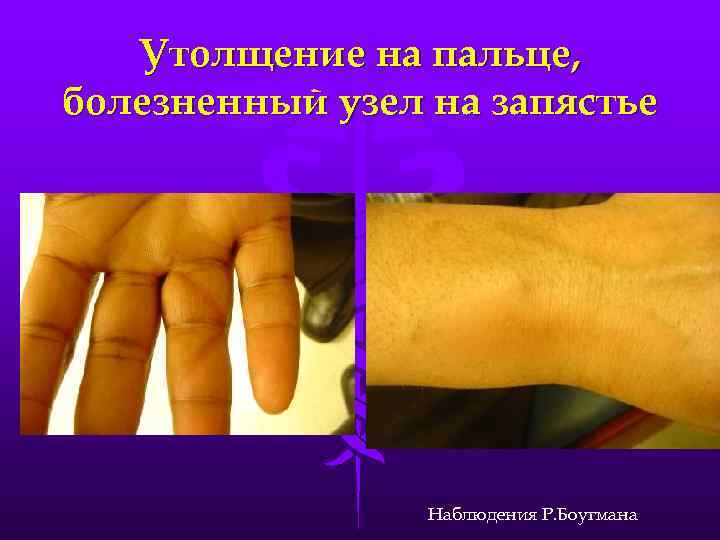 Утолщение на пальце, болезненный узел на запястье Наблюдения Р. Боугмана 