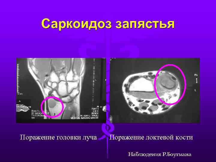 Саркоидоз запястья Поражение головки луча Поражение локтевой кости Наблюдения Р. Боугмана 