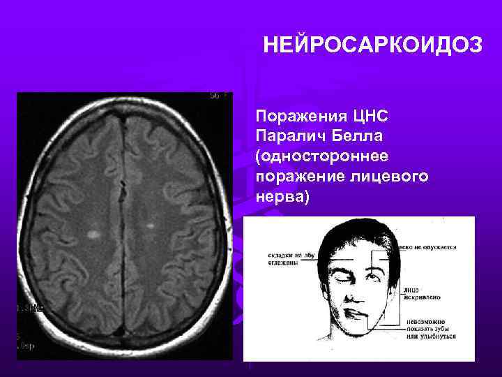 НЕЙРОСАРКОИДОЗ Поражения ЦНС Паралич Белла (одностороннее поражение лицевого нерва) 