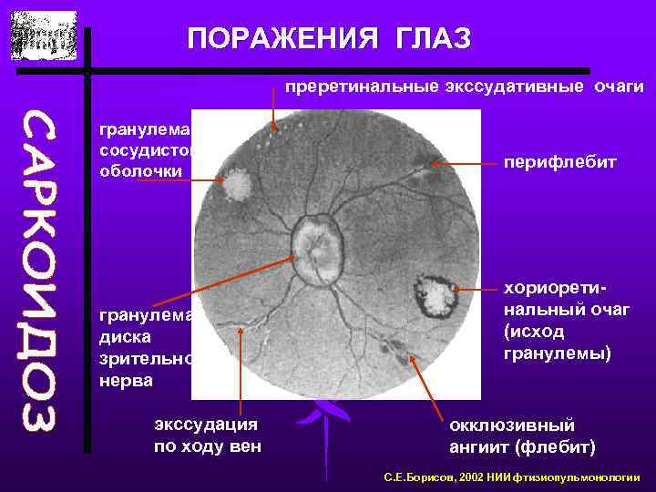 ПОРАЖЕНИЯ ГЛАЗ преретинальные экссудативные очаги гранулема сосудистой оболочки гранулема диска зрительного нерва экссудация по