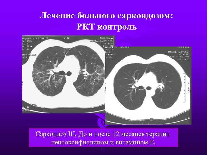Лечение больного саркоидозом: РКТ контроль Саркоидоз III. До и после 12 месяцев терапии пентоксифиллином
