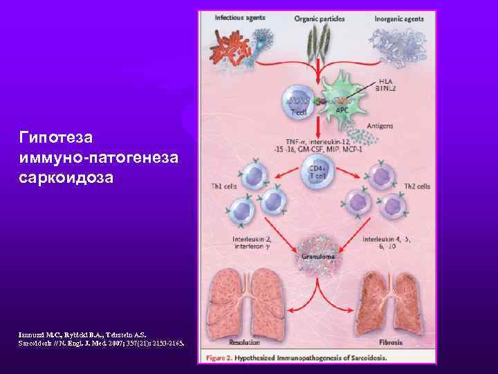 Гипотеза иммуно-патогенеза саркоидоза Iannuzzi M. C. , Rybicki B. A. , Teirstein A. S.