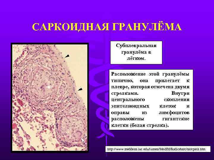САРКОИДНАЯ ГРАНУЛЁМА Субплевральная гранулёма в лёгком. Расположение этой гранулёмы типично, она прилегает к плевре,