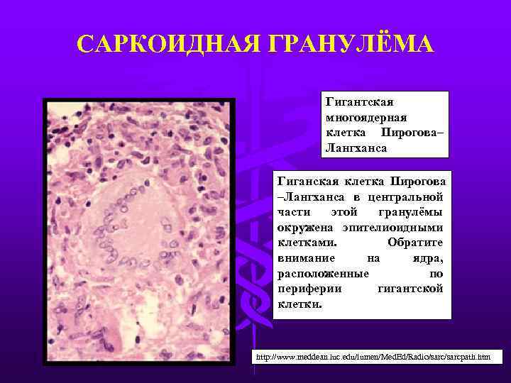 САРКОИДНАЯ ГРАНУЛЁМА Гигантская многоядерная клетка Пирогова– Лангханса Гиганская клетка Пирогова –Лангханса в центральной части