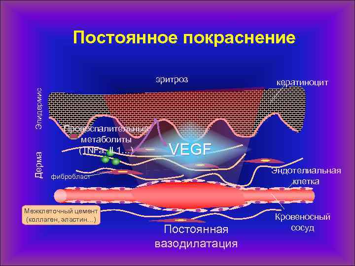 Постоянное покраснение Дерма Эпидермис эритроз Провоспалительные метаболиты (TNFa, IL 1…) VEGF Эндотелиальная клетка фибробласт
