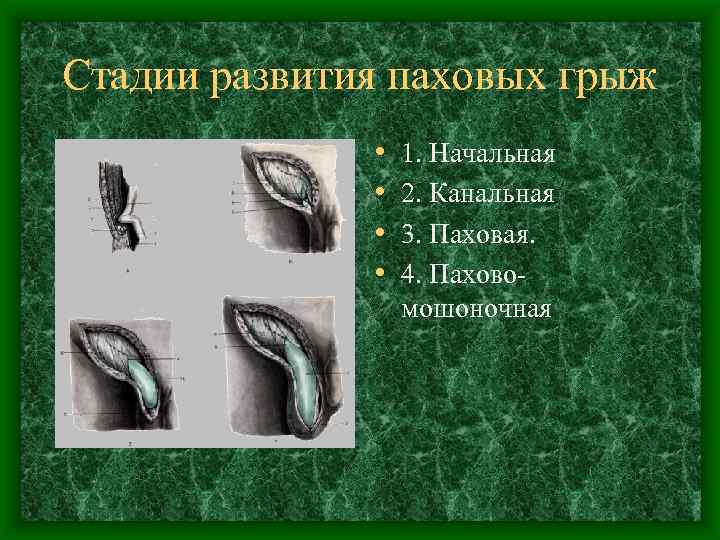 Стадии развития паховых грыж • • 1. Начальная 2. Канальная 3. Паховая. 4. Паховомошоночная