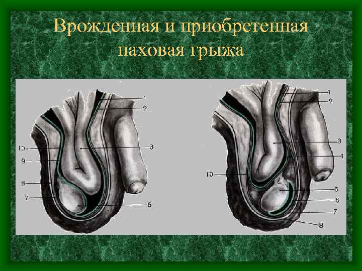 Врожденная и приобретенная паховая грыжа 