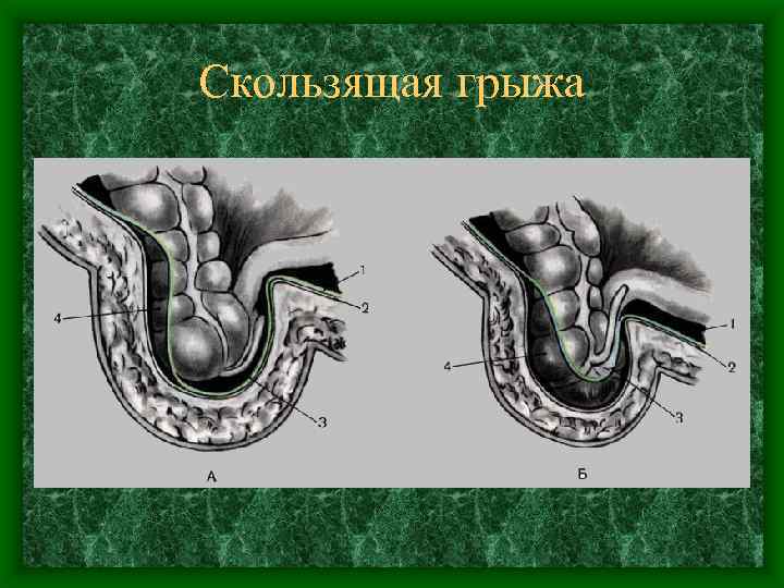 Скользящая грыжа 