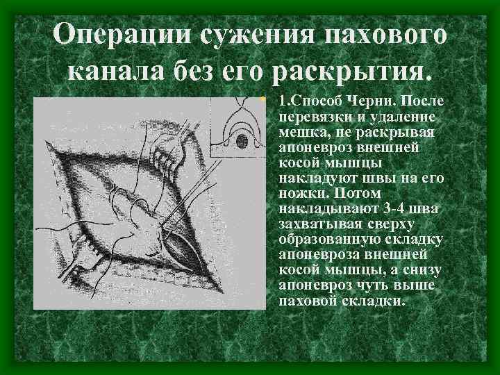 Операции сужения пахового канала без его раскрытия. • 1. Способ Черни. После перевязки и