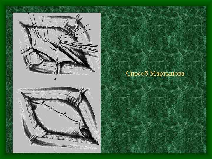 Способ Мартынова 