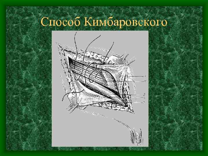 Способ Кимбаровского 