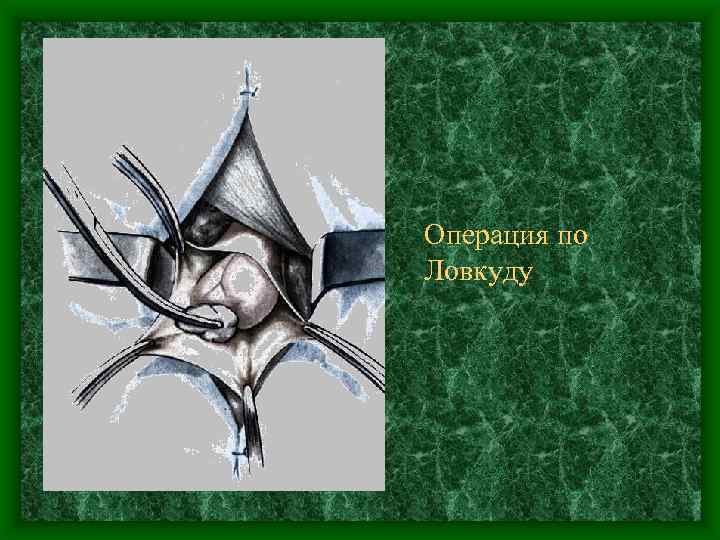 Операция по Ловкуду 