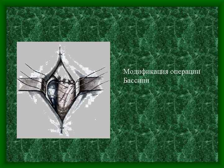 Модификация операции Бассини 