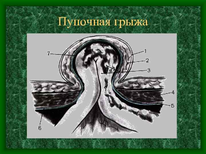 Пупочная грыжа 