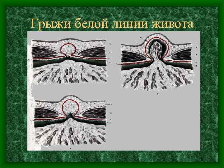 Грыжи белой линии живота 