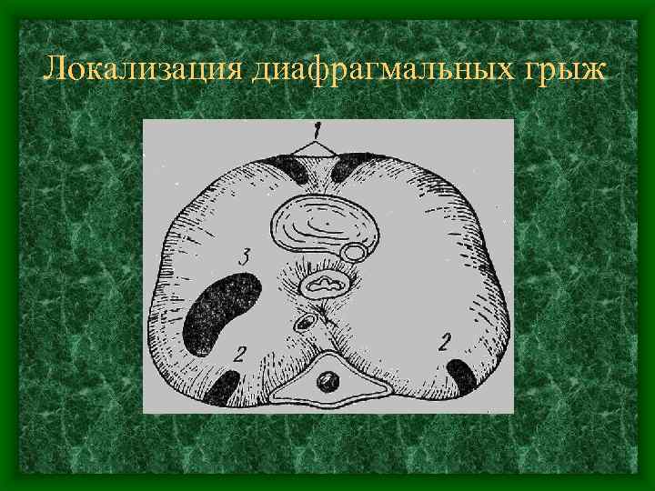 Локализация диафрагмальных грыж 