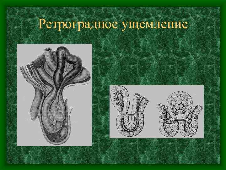 Ретроградное ущемление 