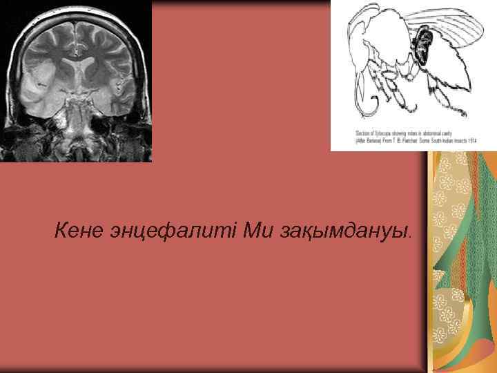 Кене энцефалиті Ми зақымдануы. 