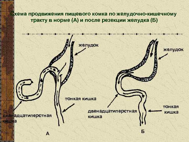 Схема продвижения пищевого комка по желудочно-кишечному тракту в норме (А) и после резекции желудка