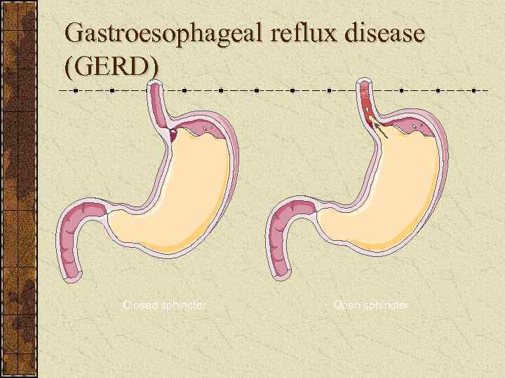 Gastroesophageal reflux disease (GERD) Closed sphincter Open sphincter 