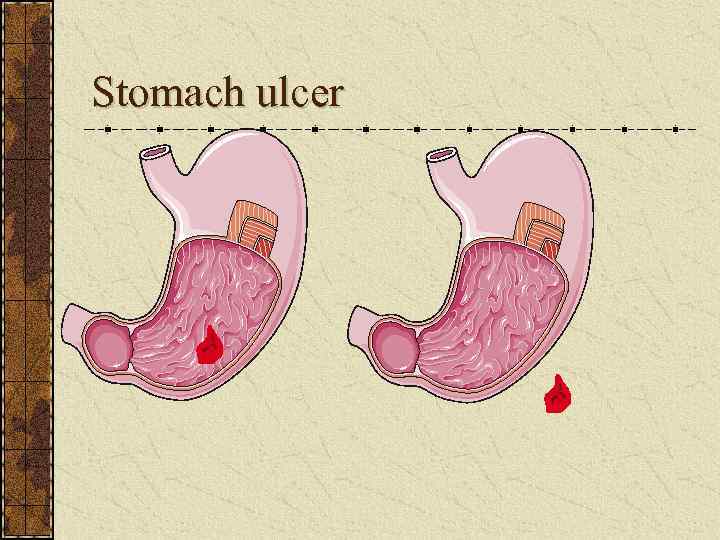 Stomach ulcer 