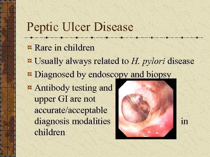 Peptic Ulcer Disease Rare in children Usually always related to H. pylori disease Diagnosed