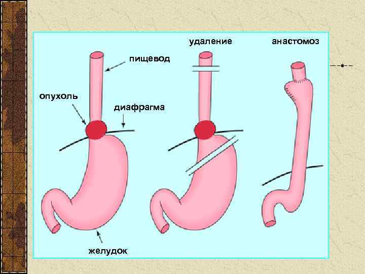 удаление пищевод опухоль диафрагма желудок анастомоз 