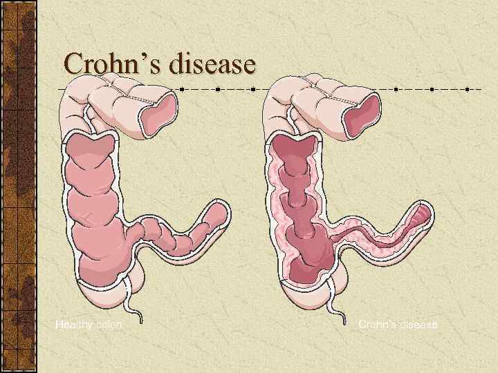 Crohn’s disease Healthy colon Crohn’s disease 